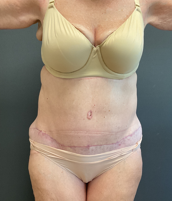 Tummy Tuck