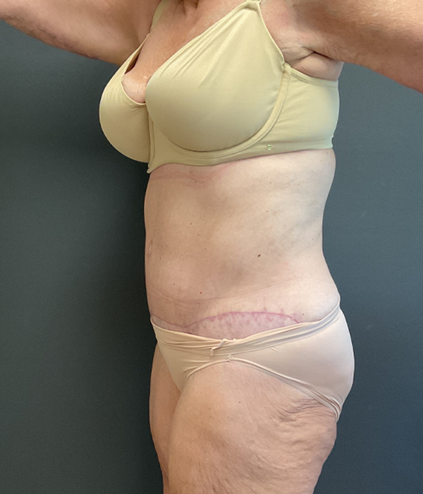 Tummy Tuck