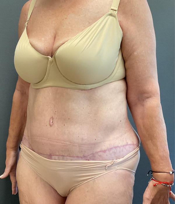 Tummy Tuck