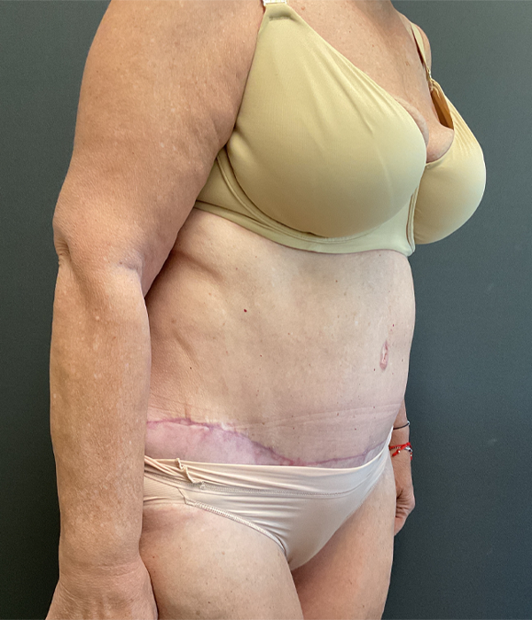 Tummy Tuck