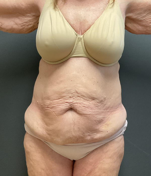 Tummy Tuck