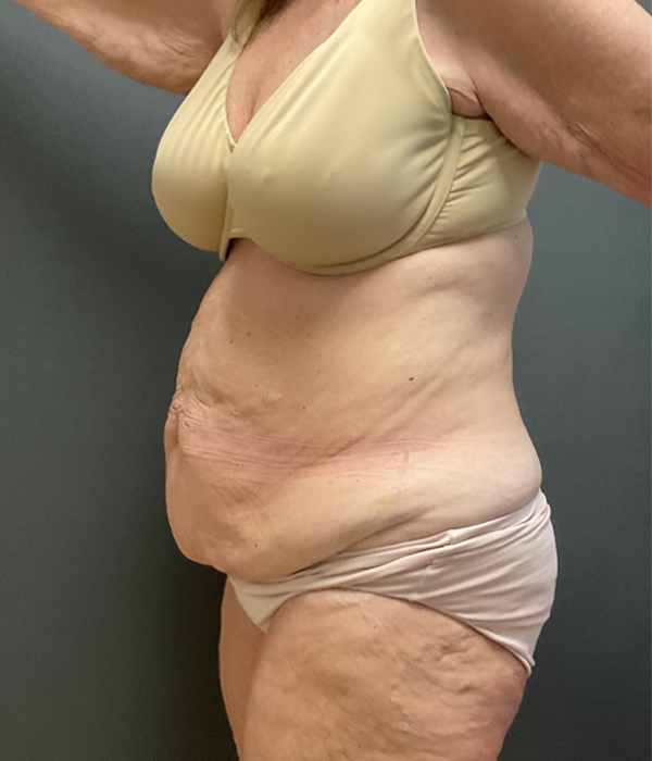 Tummy Tuck