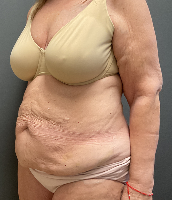 Tummy Tuck