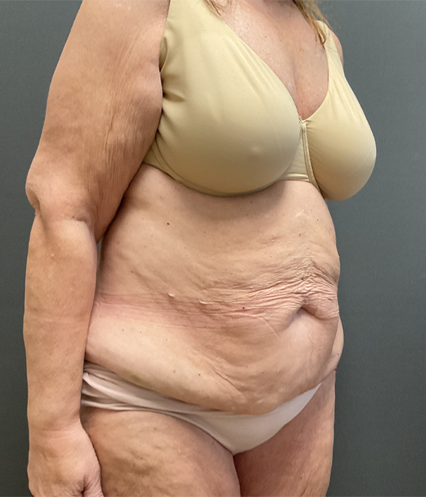 Tummy Tuck