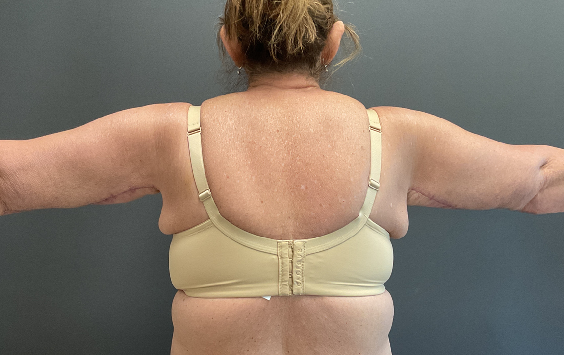 Tummy Tuck