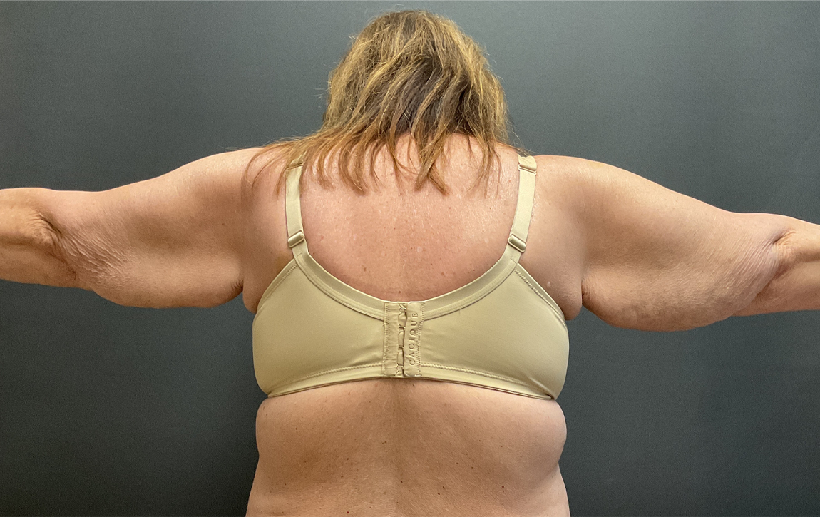 Tummy Tuck