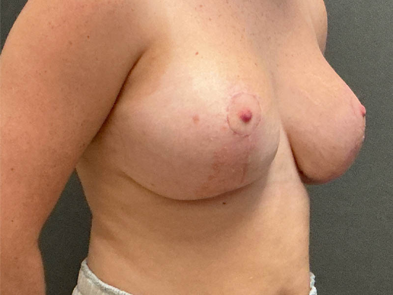 Breast Reduction