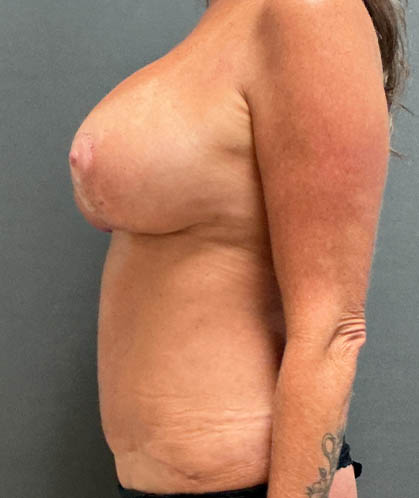 Mommy Makeover