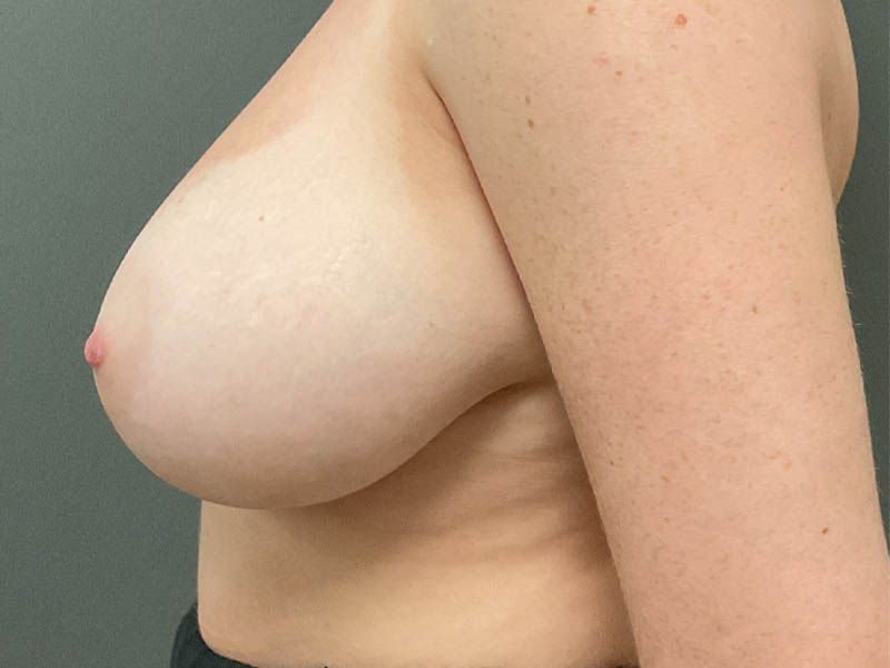 Breast Reduction