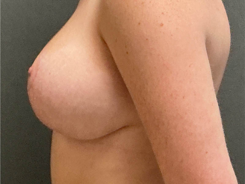 Breast Reduction