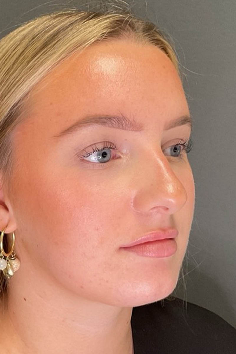 Facial Filler