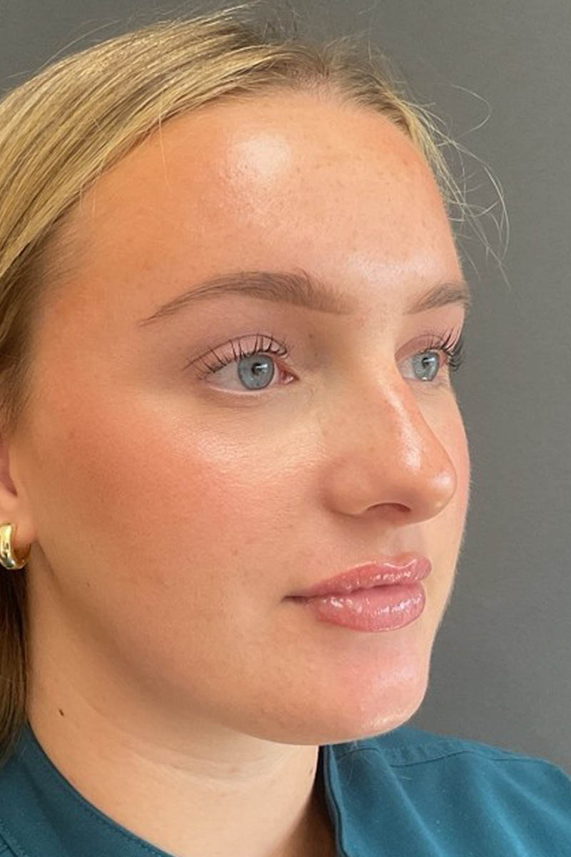 Facial Filler