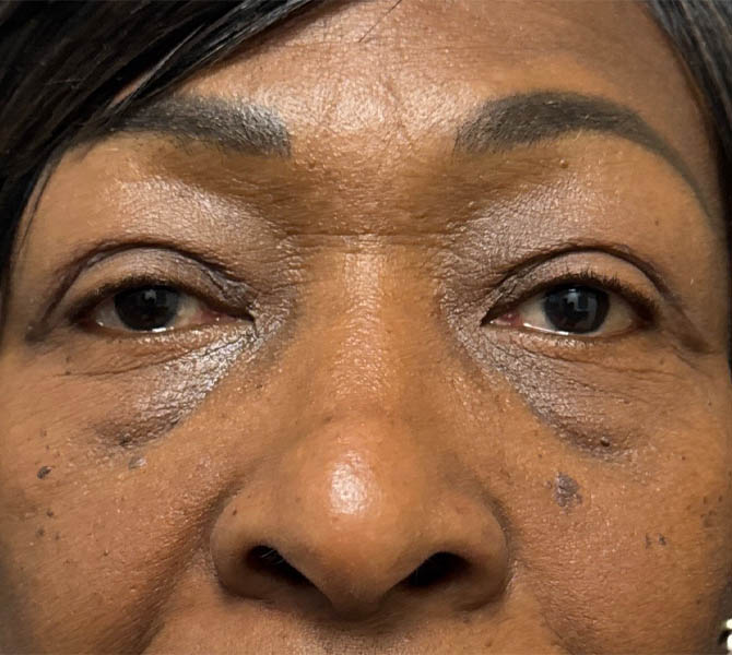 Blepharoplasty