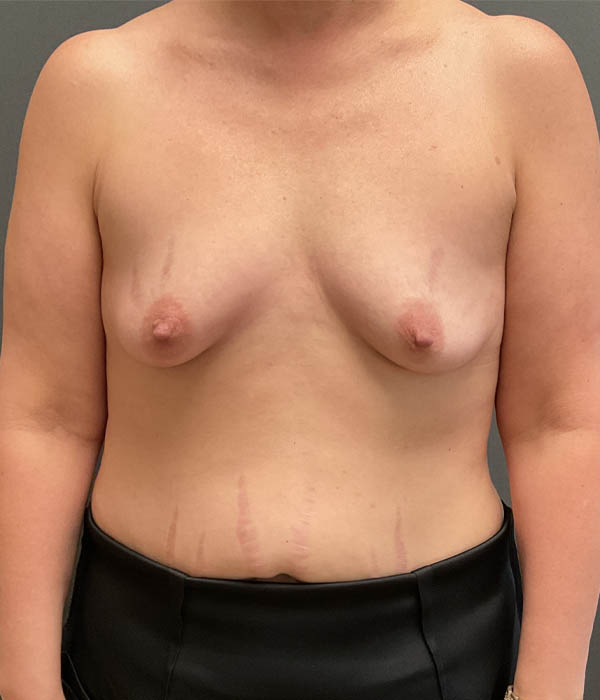 Breast Augmentation