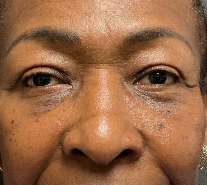 Blepharoplasty