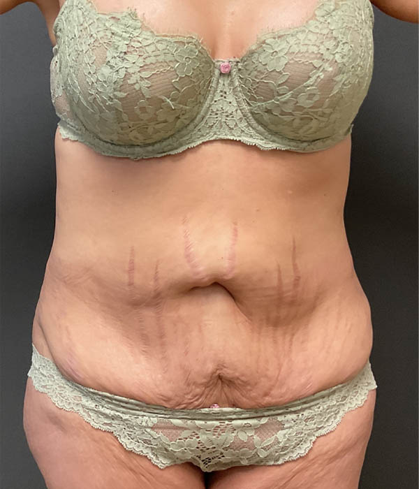 Tummy Tuck