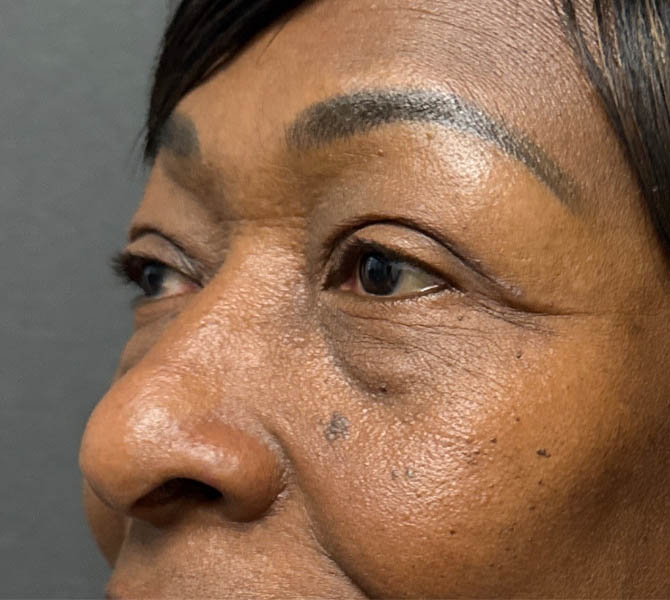 Blepharoplasty