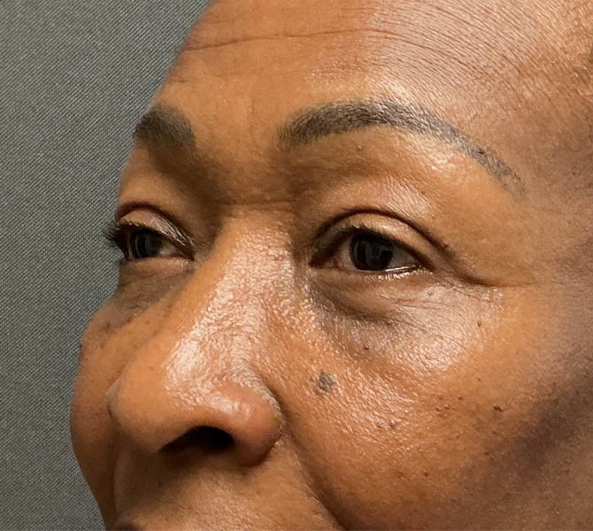 Blepharoplasty
