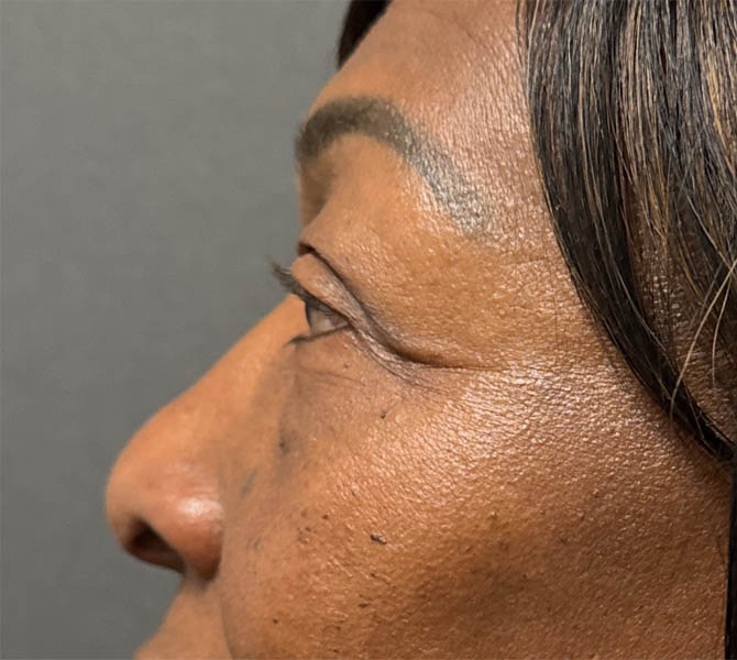 Blepharoplasty