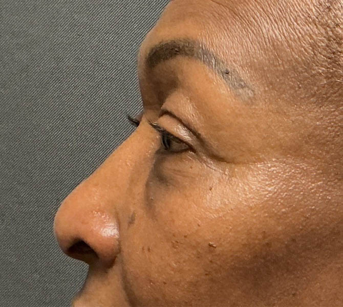 Blepharoplasty