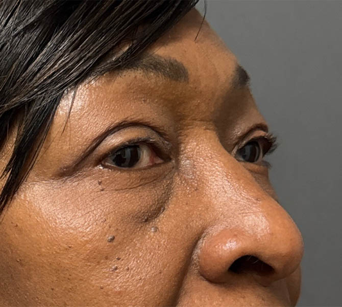 Blepharoplasty