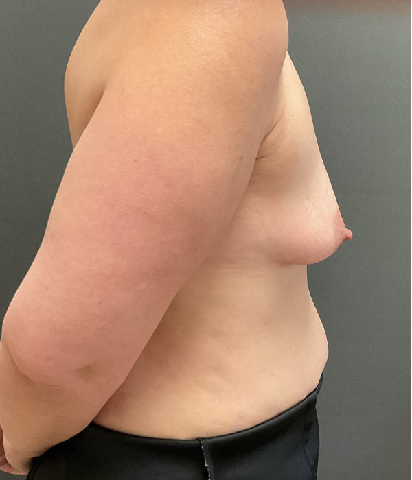 Breast Augmentation