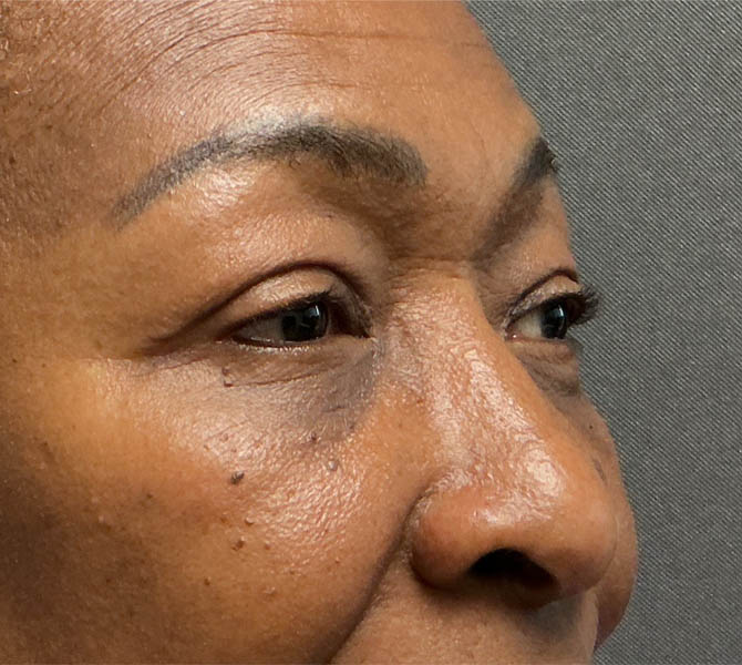 Blepharoplasty