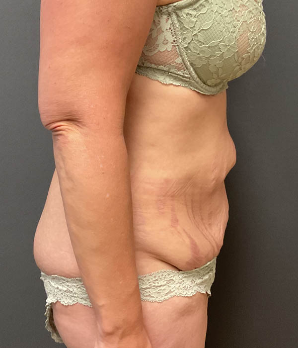 Tummy Tuck