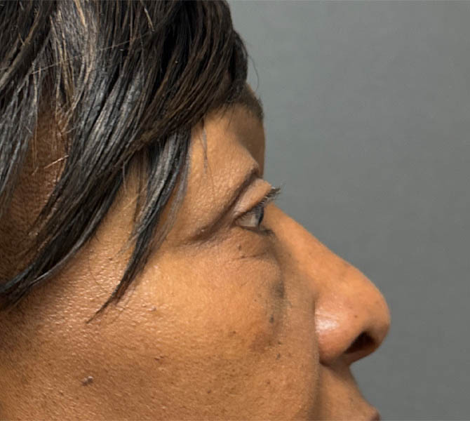Blepharoplasty