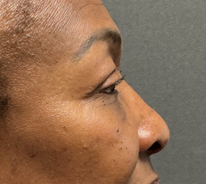 Blepharoplasty