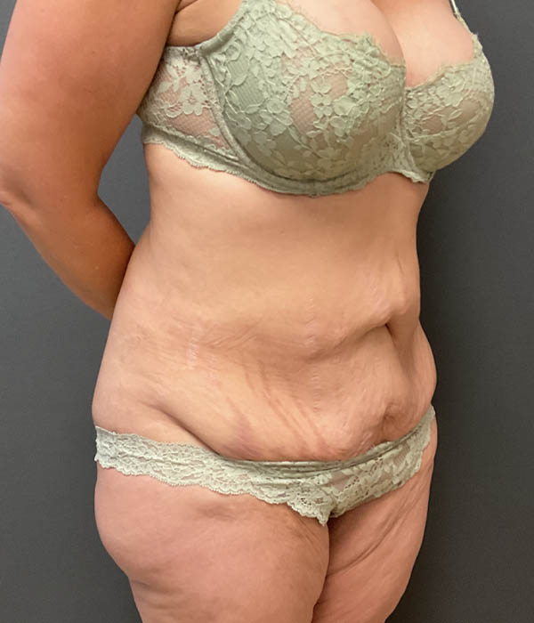 Tummy Tuck