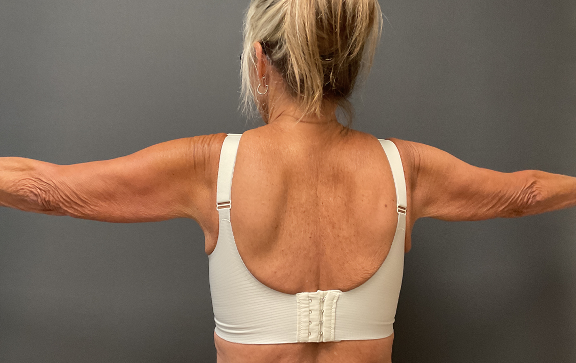 Arm Lift