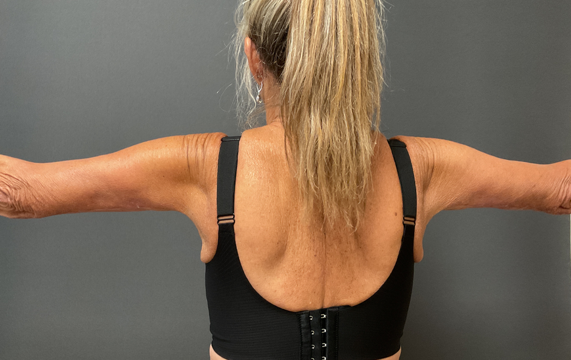 Arm Lift