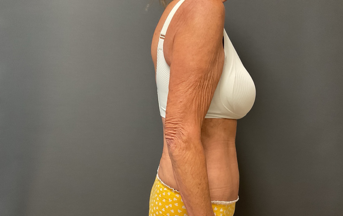Arm Lift