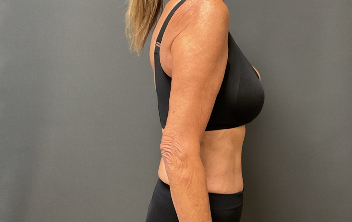 Arm Lift