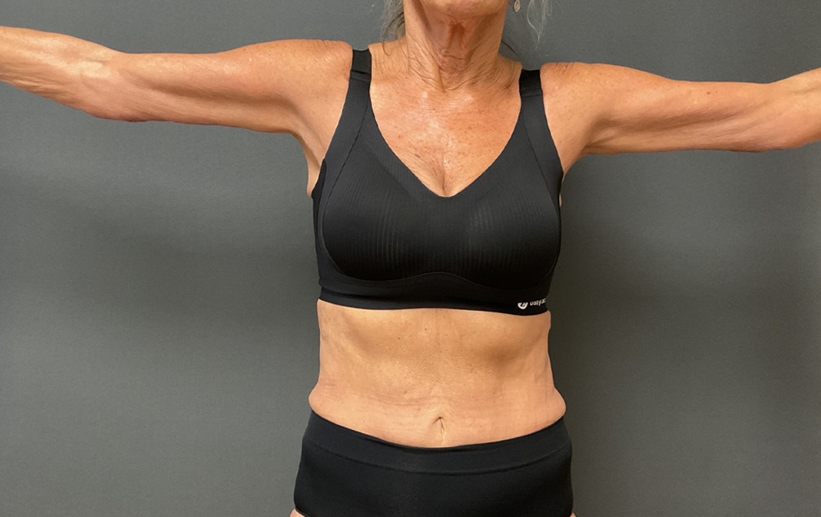 Arm Lift