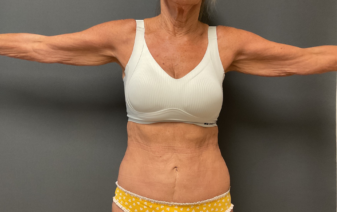 Arm Lift