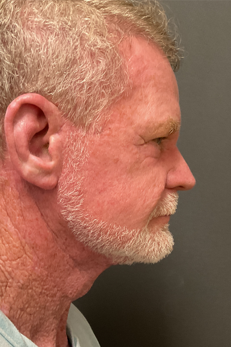 Facelift