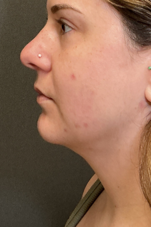 Photo Gallery Real Patient #1 after photo