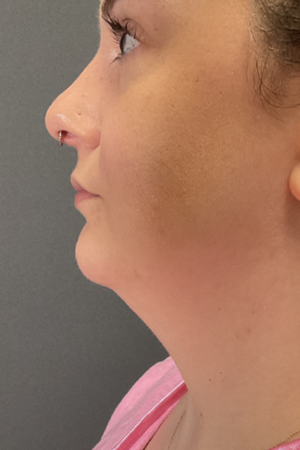 Photo Gallery Real Patient #1 before photo