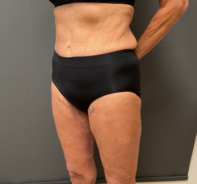 Thigh Lift