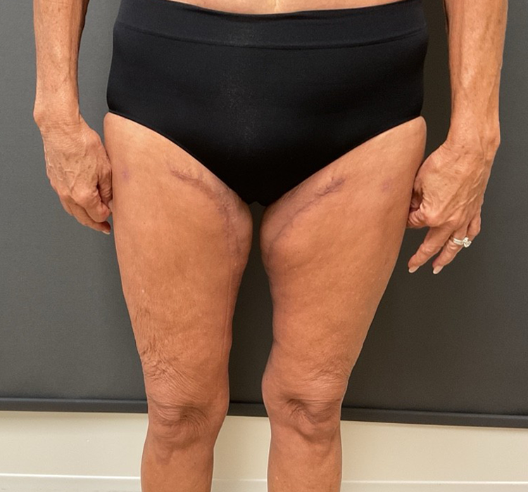Thigh Lift