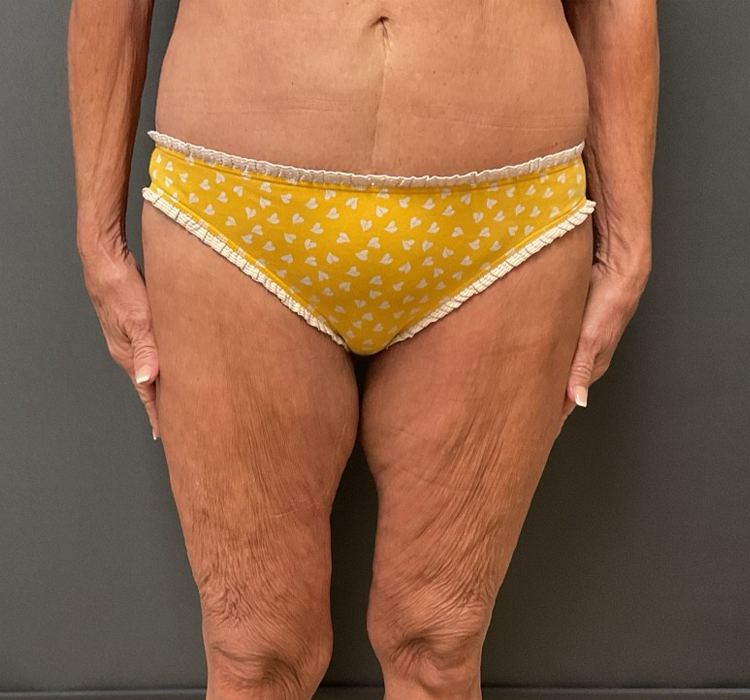 Thigh Lift