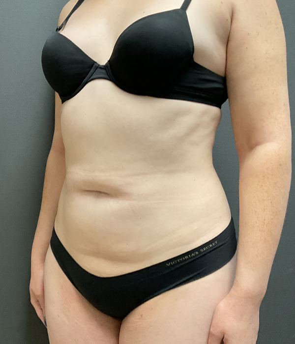 Tummy Tuck
