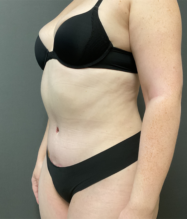 Tummy Tuck