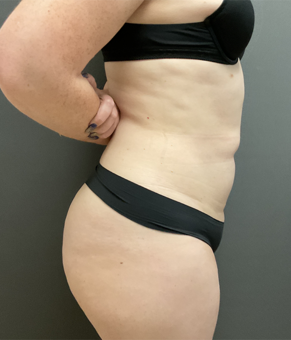 Tummy Tuck