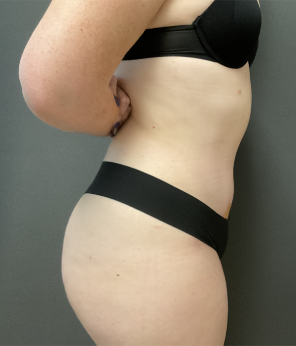 Tummy Tuck