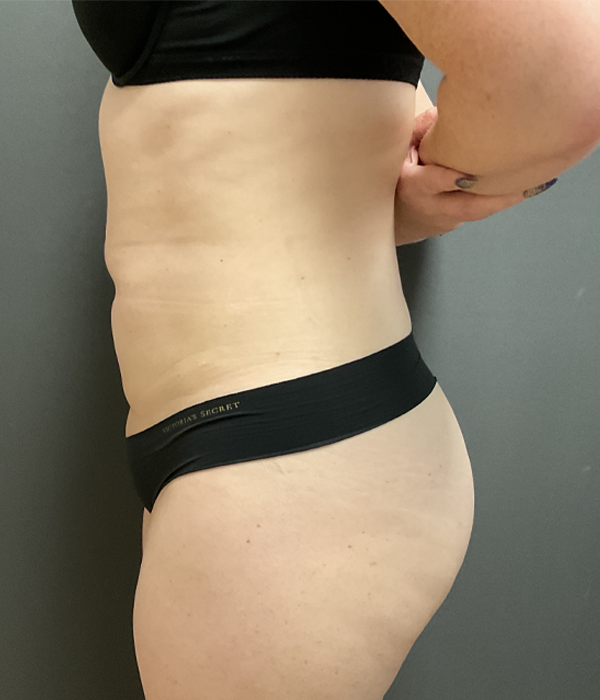 Tummy Tuck