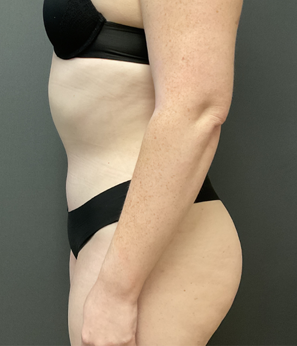 Tummy Tuck