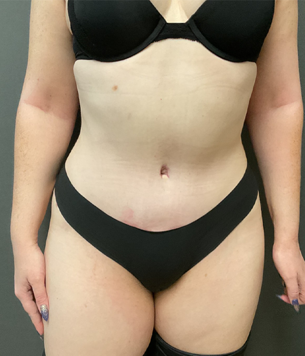 Tummy Tuck